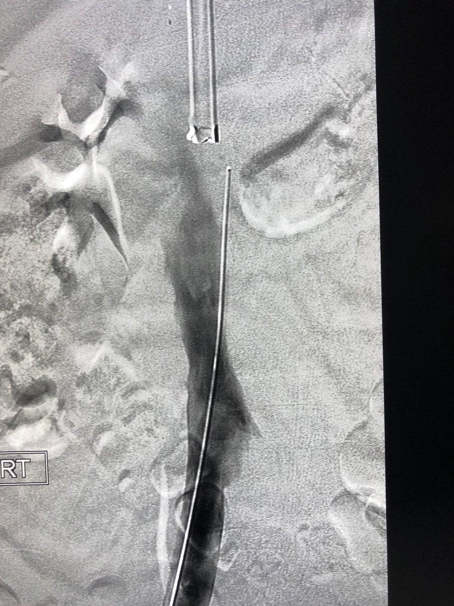 mcbreamy's tweet photo. Bane of filter existence: the #OPTEASE no match for forceps and @CookMedical sheaths #GTFO #filterout @LessneVIR @rkryu @pj_rochon @kush_r_desai https://t.co/aHJq3QrzMF