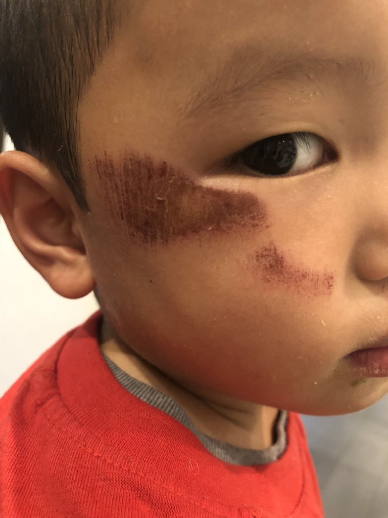 JustJasonEng's tweet image. This is what happens when Los Angeles doesn’t fix its sidewalks! The elderly, the disabled and children end up tripping and getting hurt! This continues to be a public safety hazard! @LACity @MayorOfLA @ericgarcetti @PaulKoretzCD5