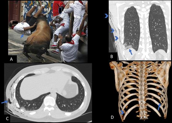 briancasey3's tweet photo. Now that's gonna leave a mark -- Medical imaging sheds light on injuries from running of the bulls in Pamplona https://t.co/snoAbmlMpC #SERAM2018 #radiology https://t.co/wFMWJEojFw