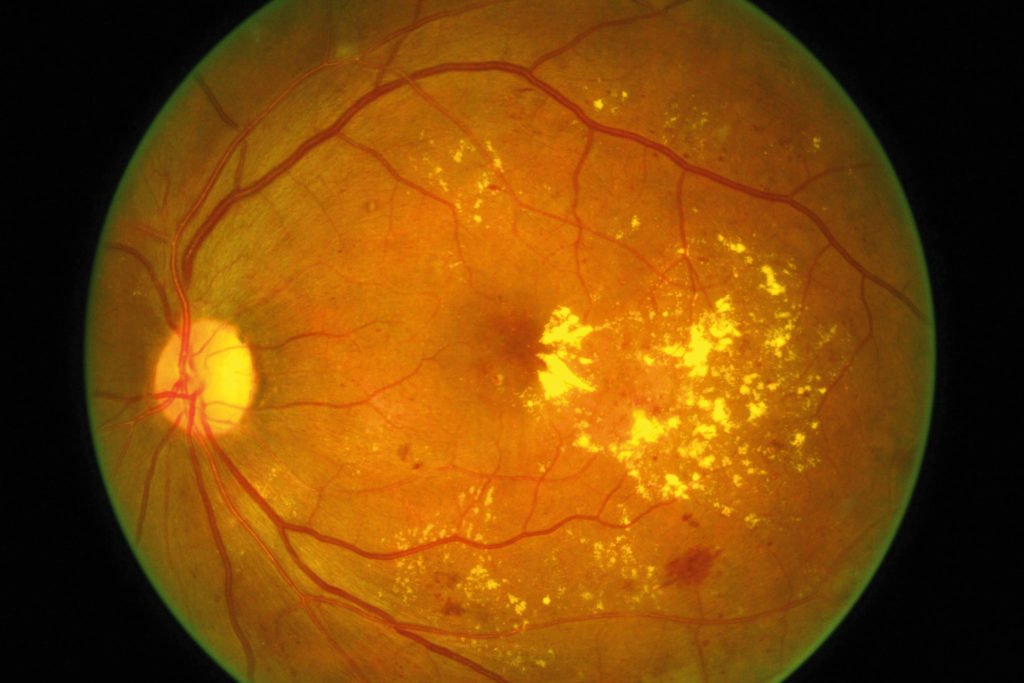 #DiabeticMacularEdema is a complication of diabetes caused by fluid accumulation in the #macula, or central portion of the #eye, that causes the #macula to swell
#Ophthalmologists #NeuroOphthalmology #RefractiveErrors #EyeLens
For more visit: ophthalmologists.euroscicon.com