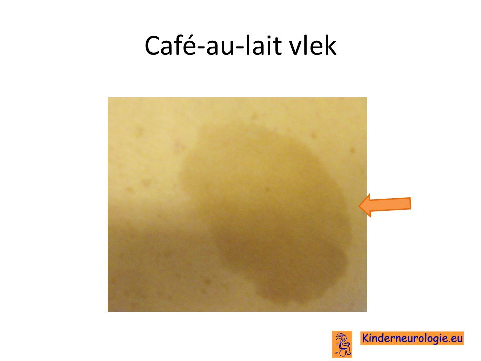 KinderneuroInfo's tweet photo. Het hebben van meer dan 5 #cafeaulait vlekken kan wijzen op de aandoening #neurofibromatose type 1, maar ook op het milder verlopende #Legius syndroom. Let dus op vlekken op de huid. Meer weten?
https://t.co/aYzexYcWp0 https://t.co/FXxepatATv