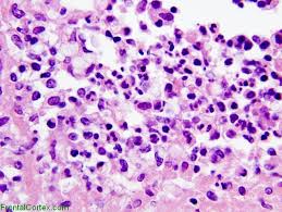 #Cryptococcal #Meningitis #Deadly #Fungal #Disease #health infectioncontrol.imedpub.com/inpress.php