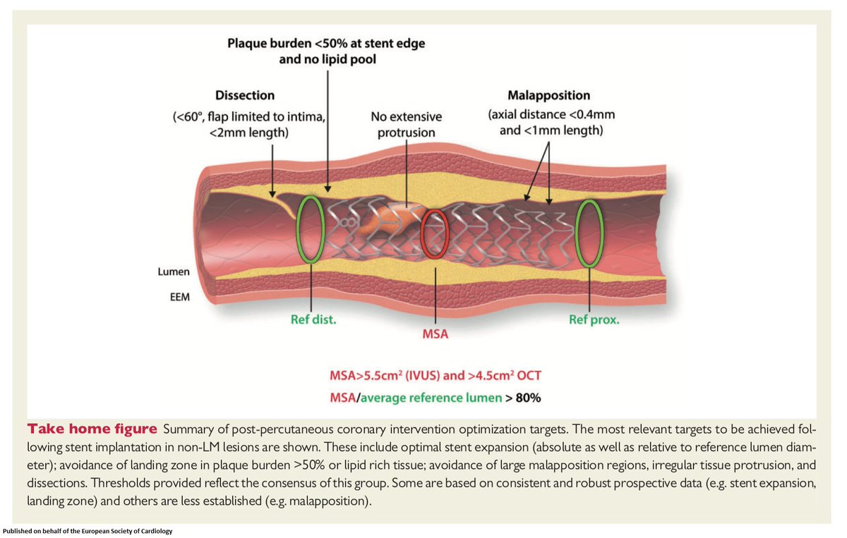 ESC_Journals's tweet image. MUST READ: Clinical use of #intracoronary #imaging - guidance and optimization of coronary interventions. An expert consensus document of the #EAPCI @escardio bit.ly/2spfkub

#PCI @PCRonline #ESCCoT #CardioTwitter #IVUS #OCT #freeaccess