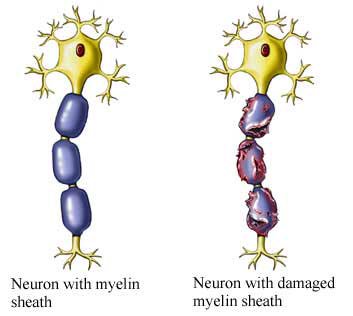 nutraceutico's tweet photo. Queridas neuronas, qué admirable vuestra función y poco que se agradece.esperemos pronto exista solución para #EsclerosisMultiple y podamos evitar tantos casos de sufrimiento y lucha admirable en niños y adultos #DiaMundialEM #healthyBrain #MultipleSclerosis https://t.co/BE1BmDu5PG