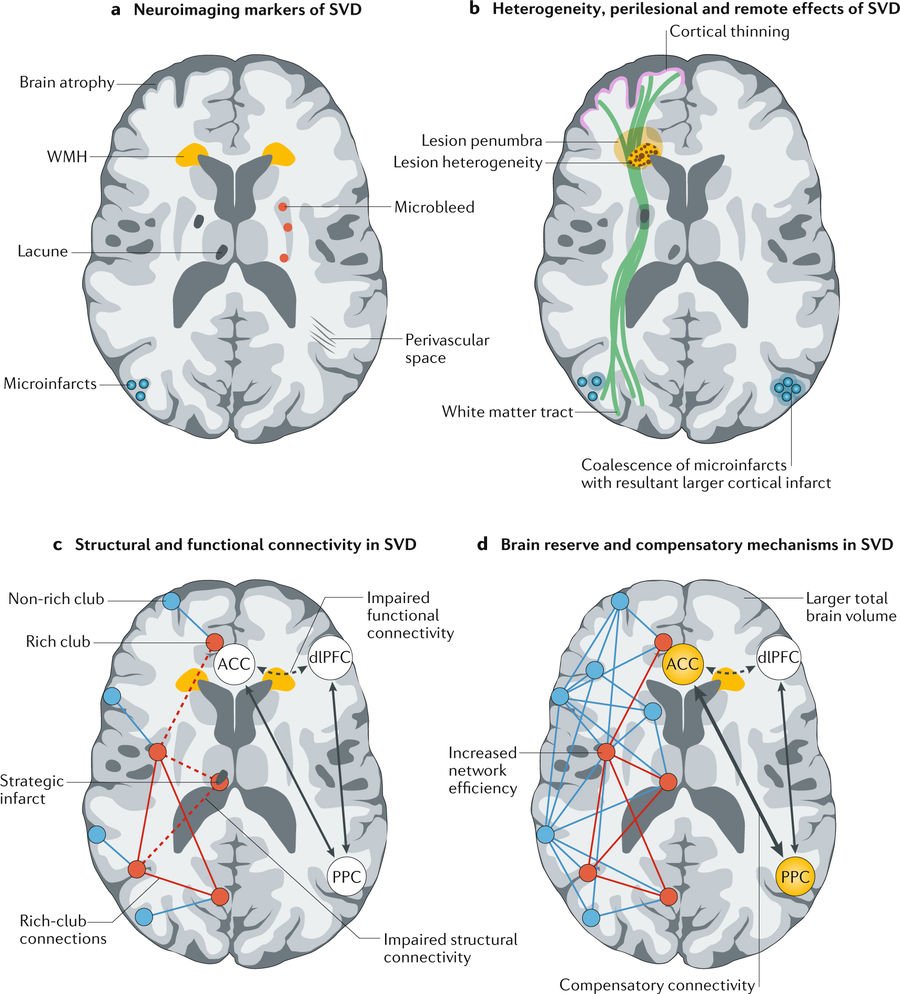 NatRevNeurol's tweet photo. New Review online | Cerebral small vessel disease: from a focal to a global perspective  https://t.co/YwJJQTPYsC #NewFromNRNeurology https://t.co/x6tpAXKF8E