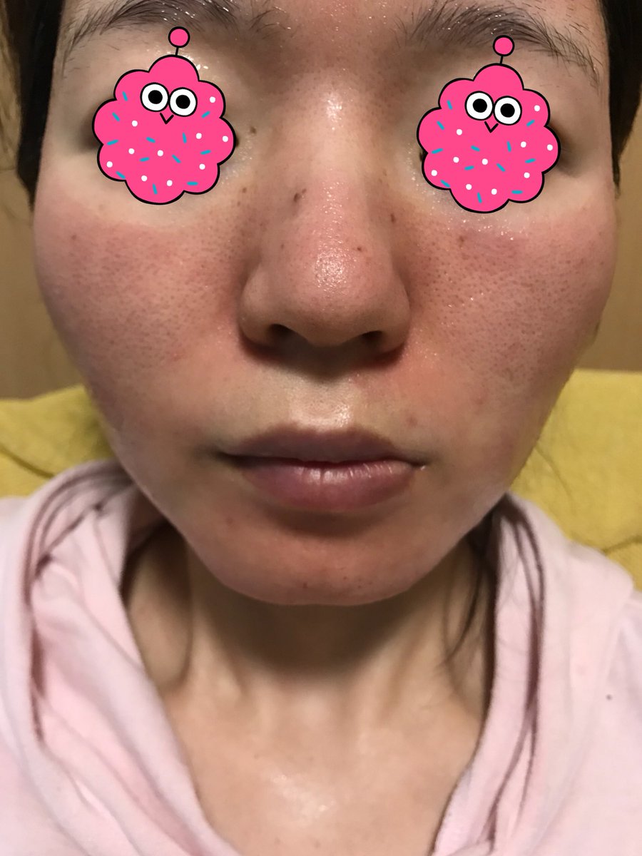 うさぎ 毛穴撲滅運動 No Twitter 顎まわりも荒れました かさぶたができたり ニキビのような ぶつぶつができて消えて 皮になってる うさぎ 毛穴撲滅運動 No Twitter 顎まわりも荒れました かさぶたができたり ニキビのような ぶつぶつができて消えて 皮になってる