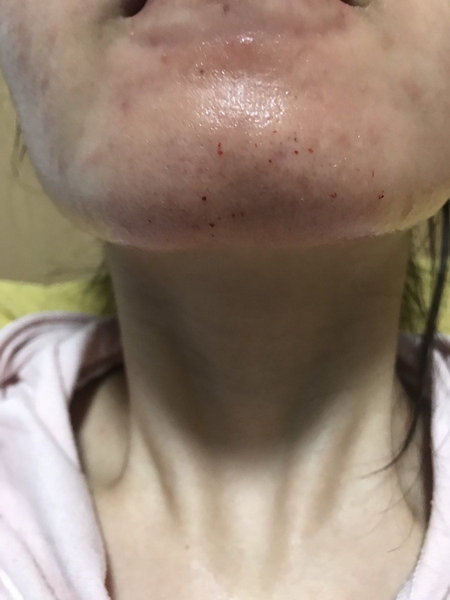 うさぎ 毛穴撲滅運動 顎まわりも荒れました かさぶたができたり ニキビのような ぶつぶつができて消えて 皮になってる