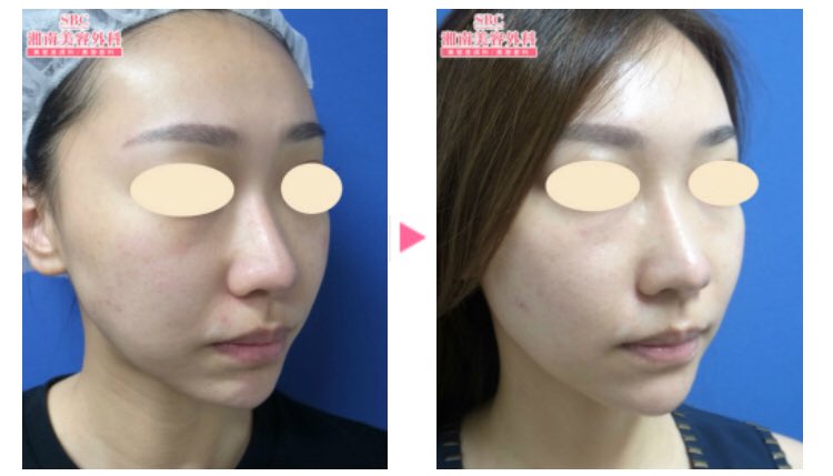 ゆか No Twitter バッカルファットって元々顔の皮下脂肪が少ない場合に効果的で 1 2枚目 皮下脂肪 が多い場合は効果イマイチだなぁ 3 4枚目 脂肪吸引の方がやりたくなってきた