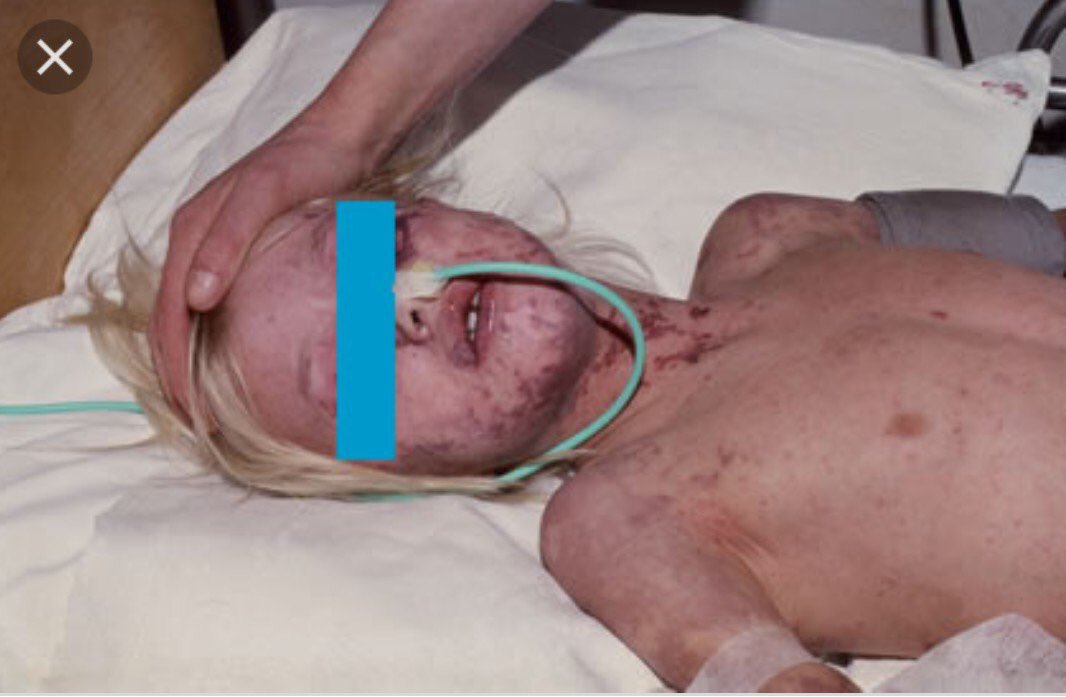 shossontwits's tweet photo. Beelden zeggen alles.
De foto die media vaak bij nieuws over vaccinatie plaatsen (een huilend kind) versus de foto die er bij geplaatst had moéten worden (levensgevaarlijk ziektebeeld). https://t.co/10yDAfUihI https://t.co/YGlcyf7JrX