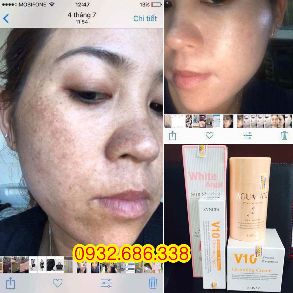 VanLe_Skinaz's tweet photo. Liệu trình quét sạch #nám, #tàn_nhang chỉ với 4sp #Skinaz HQ kết hợp DƯỠNG - PHỤC HỒI - ĐẶC TRỊ và BẢO VỆ da, sd 6-8 tháng:
+Tinh chất bơ
+Kem dưỡng trắng V10
+Serum đặc trị nám V10
+Kem chống nắng SPF 50+, PA+++
👉 https://t.co/wsj0IsgT9a
📲 #Vân_0932686338 https://t.co/YkuCHtioN1