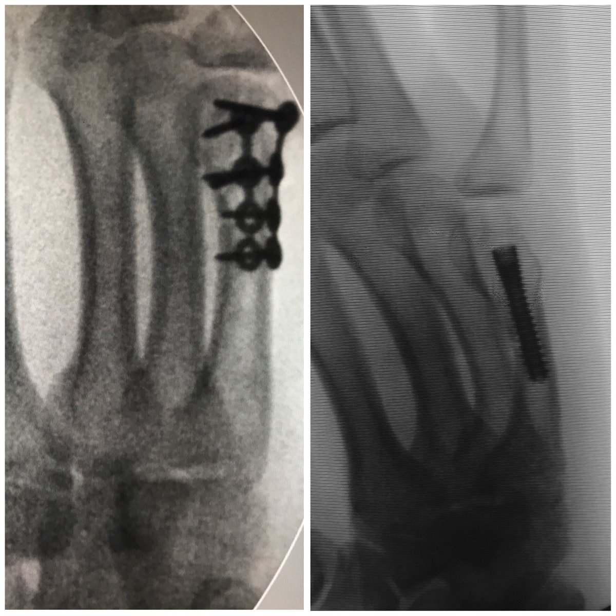 DrMarinGuijarro's tweet photo. A la 👈🏻 una #fractura #conminuta de 5MC. A la 👉🏻 un trazo oblícuo simple. La #osteosintesis #percutanea no siempre está indicada. Selección de paciente. Diferentes fracturas, diferentes opciones. @ClinicaCEMTRO #HandSurgery https://t.co/GYlWa6a4z2