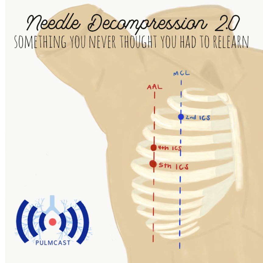 pulmcast's tweet photo. New post! Needle decompression 2.0 - why 2ICS MCL may not work. #needledecompression #PTX #FOAMed #MedEd #FOAMcc https://t.co/0v1tH2gB1u https://t.co/wcwHICHv0v