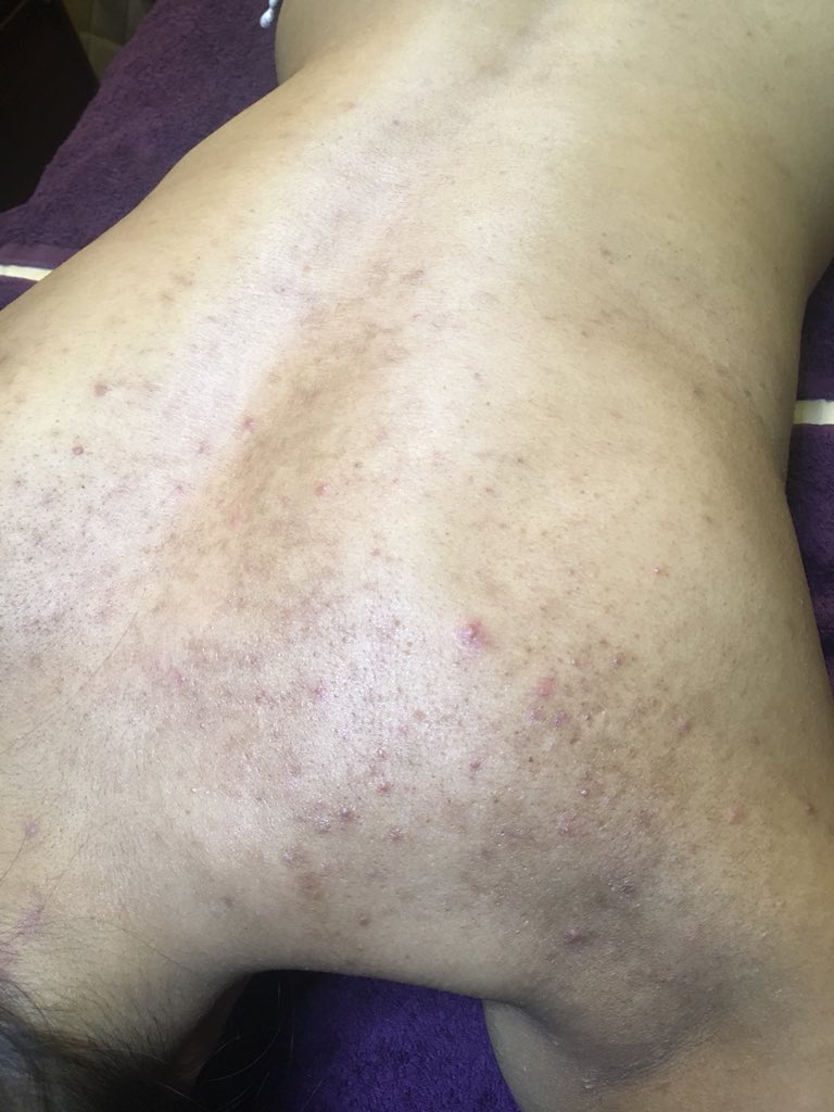 Beena_Chauhan's tweet photo. Microdermabrasion to help clear the back. Get your skin sorted for the summer! https://t.co/ish3rGdGpt