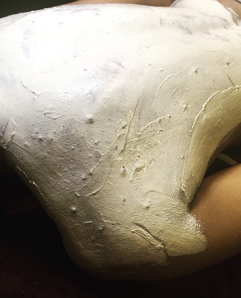 Beena_Chauhan's tweet photo. Microdermabrasion to help clear the back. Get your skin sorted for the summer! https://t.co/ish3rGdGpt