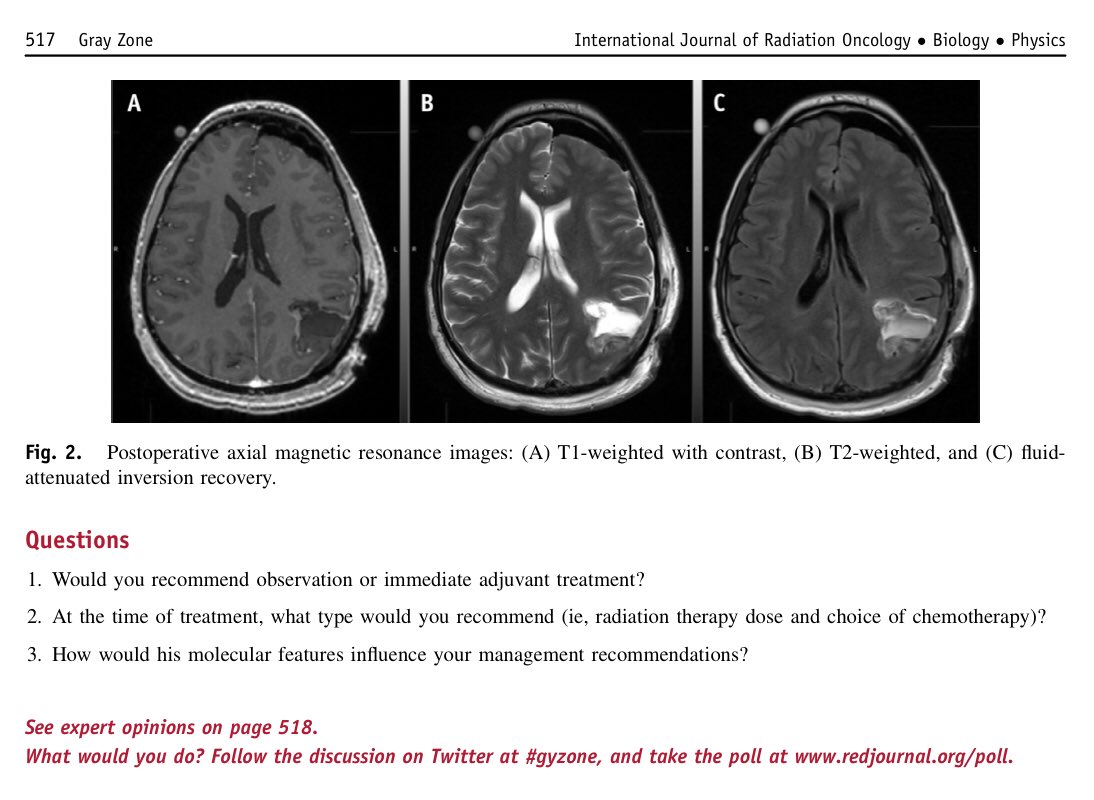 This month’s #gyzone case explores adjuvant therapy decision-making in low grade glioma: Where do you draw the line? bit.ly/2H7IJhQ #btsm #radonc #openaccess