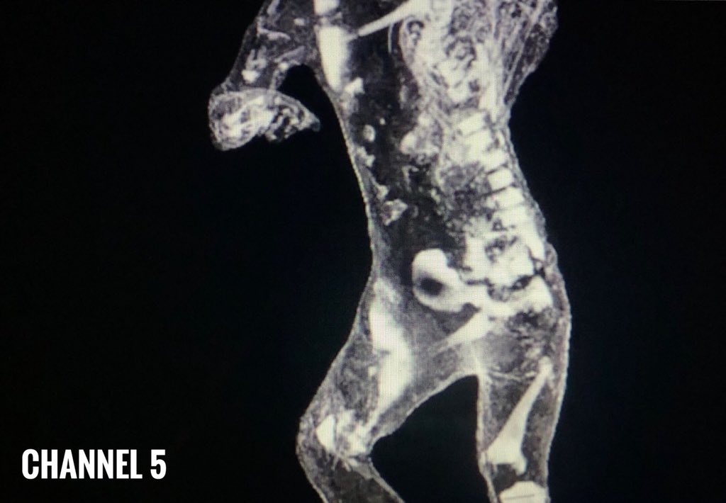 pompei79's tweet photo. But the scans of the 2 individuals were great!
A presumed man was possibly a woman & a presumed hulking great African slave/gladiator turned out to be a juvenile probably in his late teens.
Scanning the casts is producing no end of surprises which is wonderful. #LastDaysofPompeii https://t.co/cGv4EkiCoL