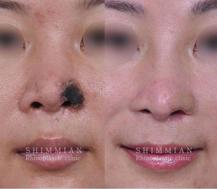 症例写真👼】 フィーラー注射や他院での手術後に拘縮になってしまった