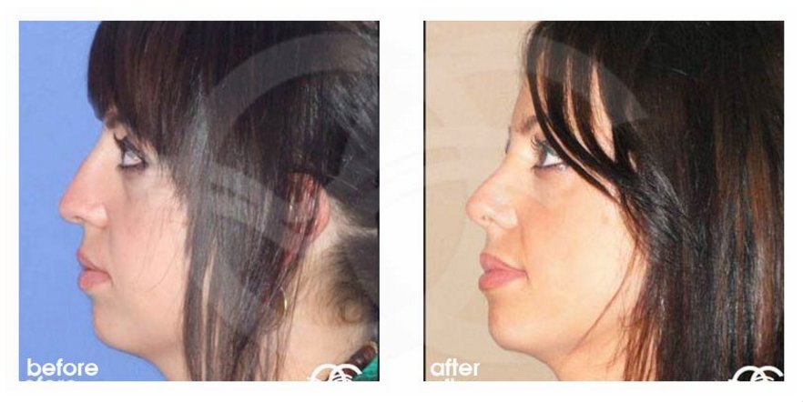 oceancli's tweet image. Will other people perceive you differently after #rhinoplasty? Research shows how perceptions change: oceanclinic.blogspot.com/2018/04/will-n…