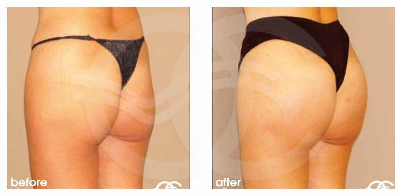 oceancli's tweet image. "You can't have a #BBL if you're thin" - we bust that and 9 other myths about buttock augmentation: ow.ly/QjZC30kgwiU