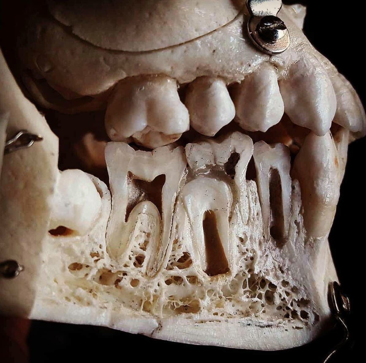 Dentagama's tweet photo. Dental anatomy of a child. You can see the permanent premolar pushing and resorbing the deciduous (baby tooth) molar. https://t.co/aJhwBoIx4P