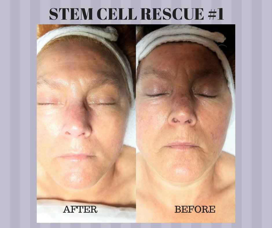 Our DermaQuest Stem Cell Rescue #1 is a wonderful stimulating and anti-aging facial.  Here is one of our clients from a couples of weeks  ago.  She was so happy with the facial and the results.  Book your Stem Cell Rescue #1 facial today by calling (519) 583-0706 Ext. #2.