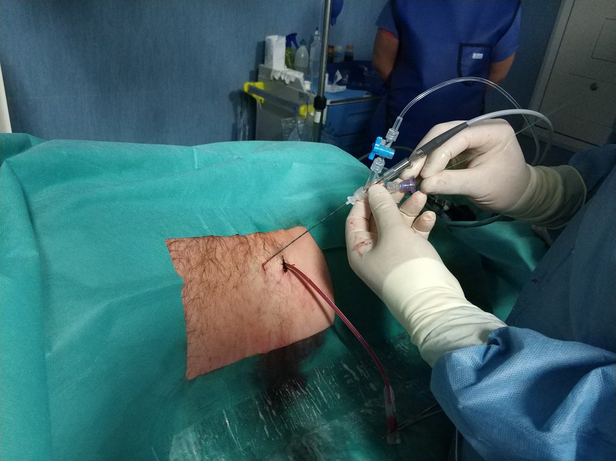 Four renal stones treated by mini and micro PCN today. #miniPNL #microPNL #IliyaSaltirov #KremenaPetkova #OgnyanGatsev, #StefanHristoforov