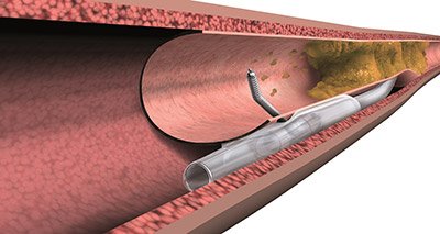CRT_meeting's tweet image. Check out this #SlidePresentation on the #hybrid approach to #PCI for #CTO:

qoo.ly/ps8a2
