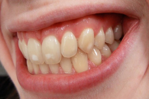 Dental_First's tweet photo. LOS DIENTES Y LA INTOLERANCIA AL GLUTEN. - https://t.co/Dubr3PK6LR #dentalfirst #prevención #salud #gluten #dientes https://t.co/cLet4olcRv