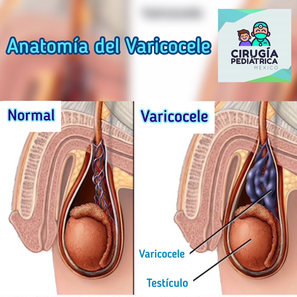 CirugiaPediaMex's tweet photo. Varicocele
Es la principal causa de infertilidad en hombres. Se puede detectar desde adolescentes y tratarla a tiempo 😮
#CirugíaPediatrica https://t.co/0GFshMWxw9