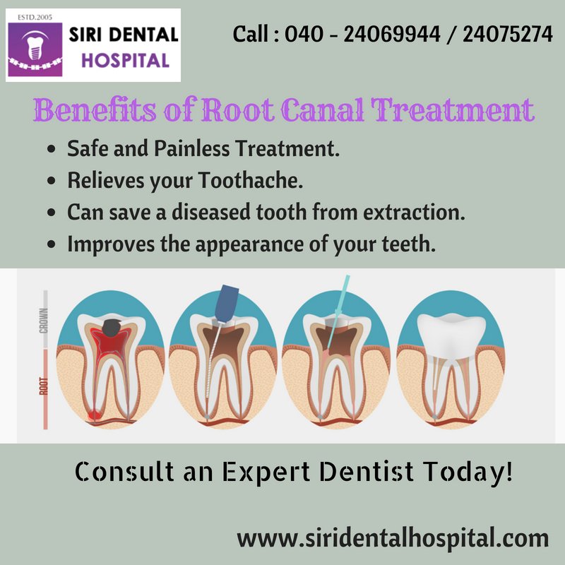Benefits of #RootCanalTreatment
1) Safe and #PainlessTreatment.
2) Relieves your #Toothache.
3) Can save a diseased tooth from extraction.
4) Improves the appearance of your teeth.
Consult an Expert #Dentist Today!
Call : 040 - 24069944 / 24075274
Visit : siridentalhospital.com/root-canal.php