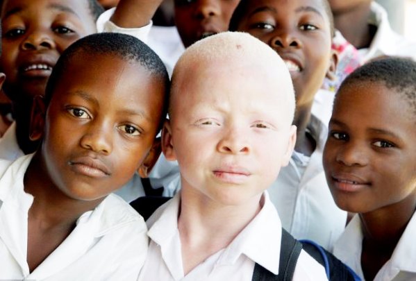 Nkulie14's tweet photo. Let us amplify the message condemning the abuse of an Albino child, their condition does not make them lesser human beings.. Stop Albino child abuse! #ChildProtectionWeek #ChildProtectionWeek2018 @The_DSD @gpgSocDev @DBE_SA @Abramjee @ChangeAgentSA @UNHumanRights @marisagerards https://t.co/feuDKR8nbC