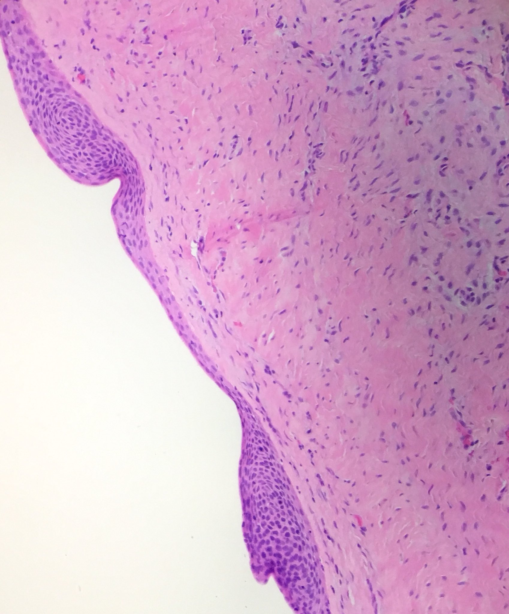 botryoid odontogenic cyst