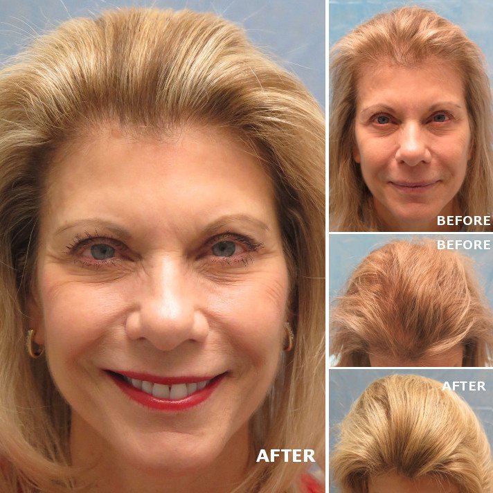 Many falsely believe that only men experience #hairloss but 40% of people with hair loss are women. Read more here: bit.ly/2IItIJf
#folliclefriday