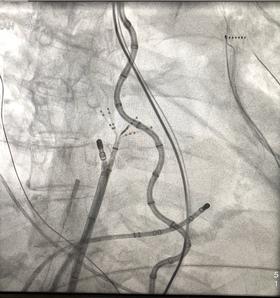 Felix Yang, MD, FACC, FHRS (@fyang_ep) on Twitter photo Posterior wall isolation is way easier when you don't have to worry as much about the esophagus! Thx <a href="/SteveMillerRN/">Steve Miller</a> Posterior wall isolation is way easier when you don't have to worry as much about the esophagus! Thx <a href="/SteveMillerRN/">Steve Miller</a>