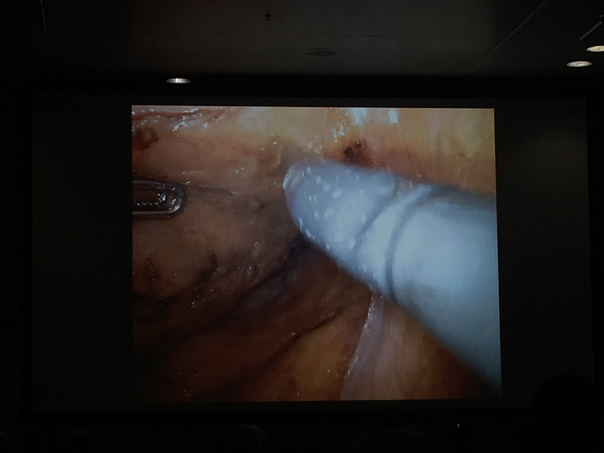 NuhaZsurgeon's tweet photo. Robotic vs TaTME - unedited videos by Amjad Parvaiz and @AntoniodeLacy - although the tools are different, the anatomy has always been the same.. Fab session @EAES_eu #ColorectalSurgery #EAES2018 (also nice to see @EwenGriffiths enjoying some world class colorectal Surgery ๐บ) https://t.co/FHGz1QW8oq