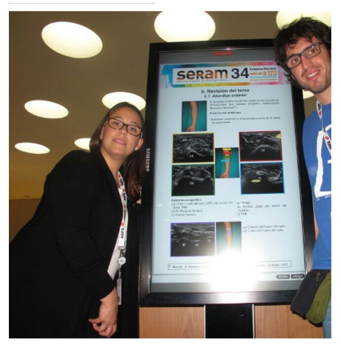 JoseMCastano's tweet photo. Maria Ariño e Isaac Pomes, #TSID del CDI del @hospitalclinic, resultaron ganadores del Premio “Magna Cum Laude” a la mejor comunicación en su categoría, de #SERAM2018, con “Estudio Ecográfico de la Inserción Distal del Tendón del Músculo Bíceps”
https://t.co/dtGlZc1uqQ
#ecografia https://t.co/Mi541SAAYQ