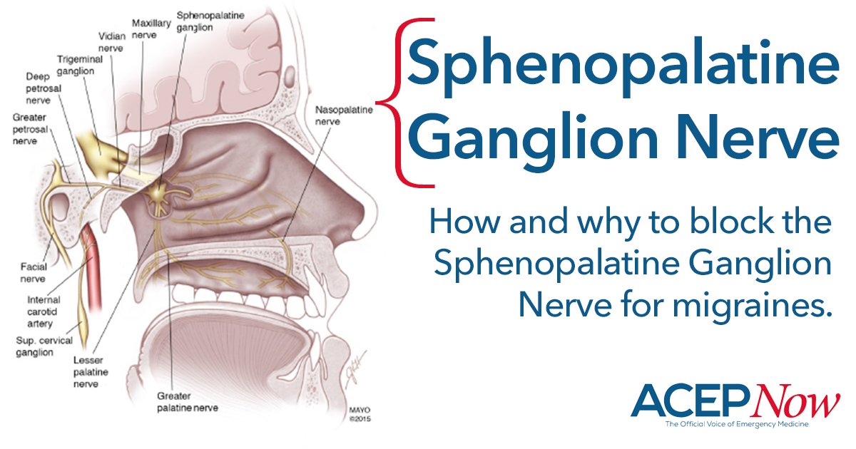 Sphenopalatine Nerve Block