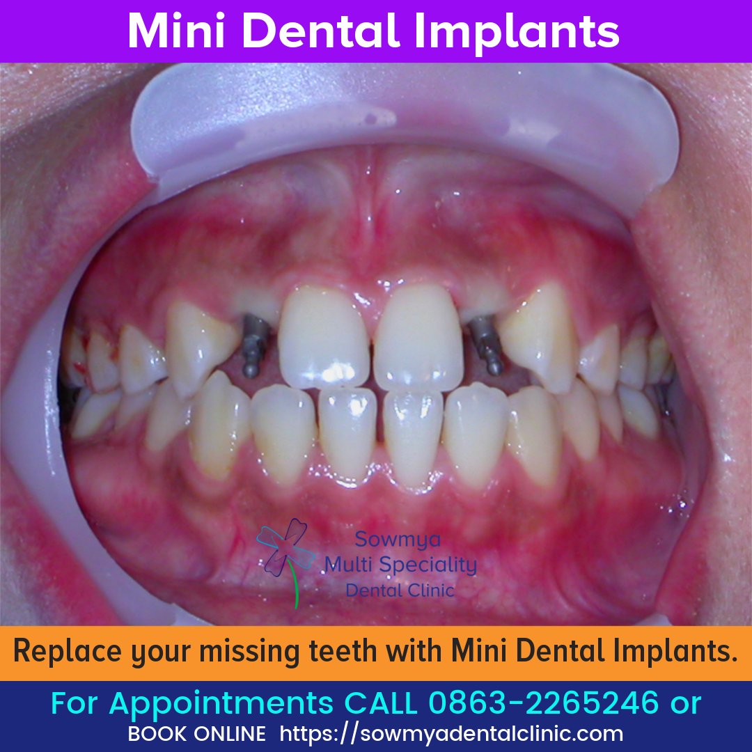 sowmyadental's tweet image. Replace your missing teeth with Mini Dental Implants.

sowmyadentalclinic.com

#dentalcaps #caps #teethcaps #dentalcrowns #teethcrowns #dentist #teethrestoration #dentalclinic #clinic #hospital #dentistry #teethreplacement #fix #teeth #guntur #miniImplants #implants #doctor