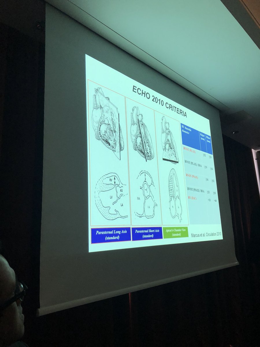MichaelPapadak2's tweet photo. Utility of ECHO and CMR on the diagnosis and risk-stratification of #ARVC / #ACM Athletic adaptation, mimics, left-dominant disease. Great talks @rach_bastiaenen and @SPapatheodorou @StGeorgesUni @StGeorgesTrust #imagingcourse https://t.co/BMLHv0lGCa