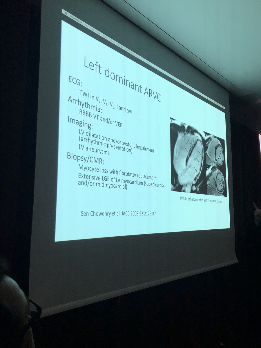 MichaelPapadak2's tweet photo. Utility of ECHO and CMR on the diagnosis and risk-stratification of #ARVC / #ACM Athletic adaptation, mimics, left-dominant disease. Great talks @rach_bastiaenen and @SPapatheodorou @StGeorgesUni @StGeorgesTrust #imagingcourse https://t.co/BMLHv0lGCa