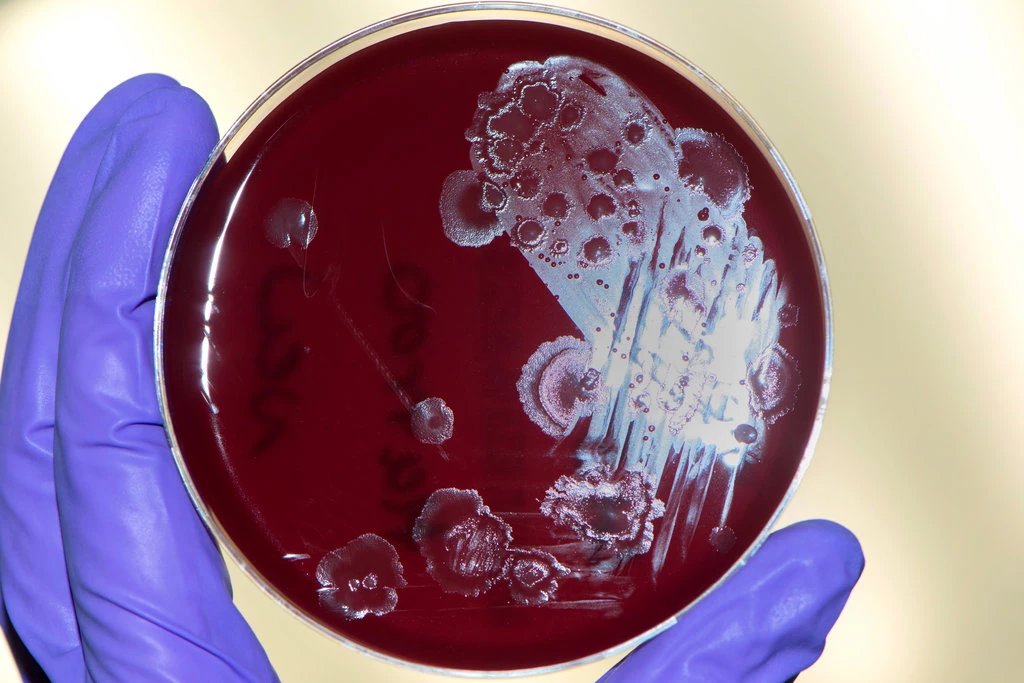 MicrobesInfect's tweet image. Fecal transplants work as well as antibiotics for severe diarrhea caused by #Clostridium difficile. 

Instead of waiting until antibiotics fail before trying fecal transplants, researchers tried giving the fecal bacteria first.

nytimes.com/2018/06/02/hea… #FMT #CDI #microbiota