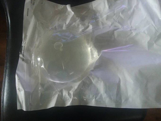 800 cc implant that was in me up for sale ! 😚$500! 1implant of 2 already sold!  DM me if you would are<a href="/tag/implants"class="tags"><span>#implants</span></a><a href="/tag/breastimplants"class="tags"><span>#breastimplants</span></a><a href="/tag/implant"class="tags"><span>#implant</span></a><a href="/tag/boobsseries"class="tags"><span>#boobsseries</span></a>