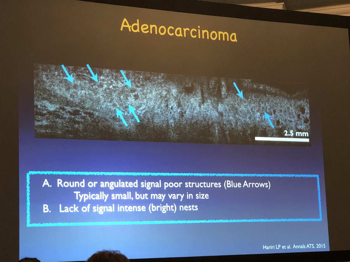 ALBoothMD's tweet photo. Dr. Lida Hariri of @MGHPathology discussing lung cancer diagnosis by optical coherence tomography #pulmpath #IVMpath https://t.co/6jJSB1OZvF https://t.co/bGiHOaBsc6