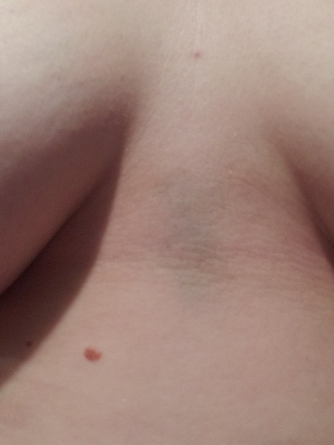 Something Great on X: How does one get a bruise from a sports bra