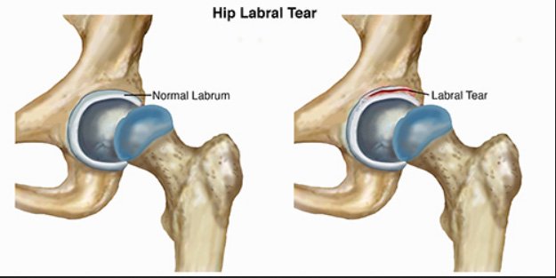 amonferrymd's tweet photo. Hip Arthroscopic Surgery With Labral Preservation and Capsular Plication in Patients With Borderline Hip Dysplasia: Minimum 5-Year Patient-Reported Outcomes. https://t.co/ut8RH9Lp4N #arthroscopy #plication #outcomes https://t.co/KvMlWTPWM8