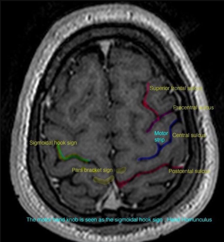 TimLuijkx's tweet photo. Useful landmarks to find the central sulcus in this @Radiopaedia article https://t.co/KB8AT8sCtp #RadAnatomy https://t.co/xNatOIM6Sv