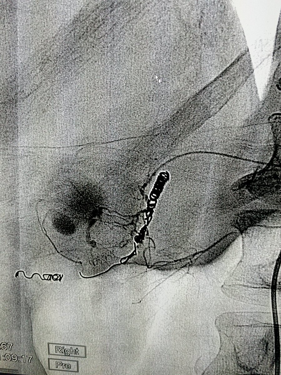 11Blade's tweet image. #irad #Embolization pesky supraduodenal branch on REDO embo from continued bleeding duodenal ulcer. Coiled with 2mm hilal and GDA capped with azur cx detachables. @terumo #learningmoment #fail