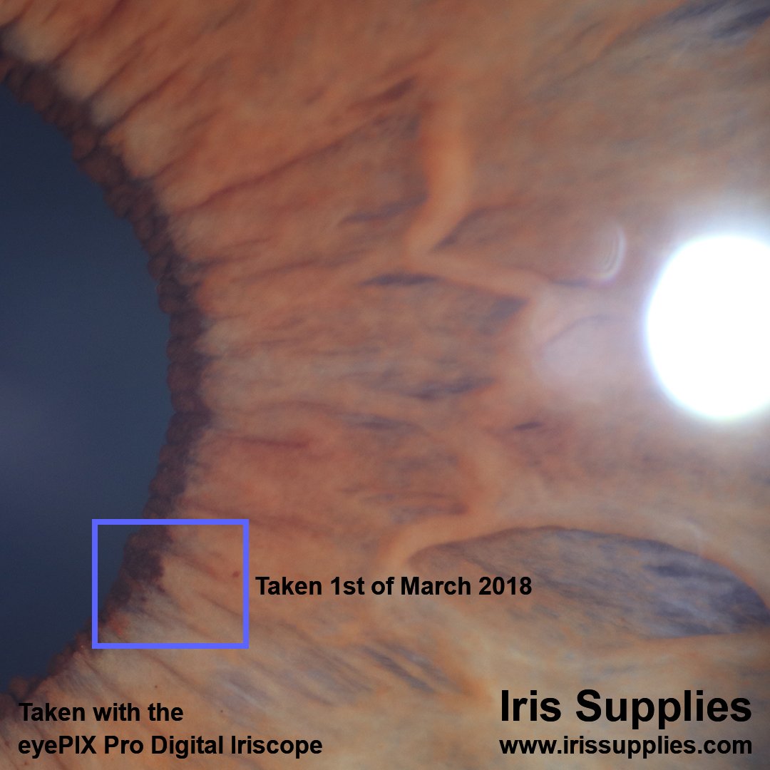 IrisSupplies's tweet photo. Take note of the blue outlined box on this magnified image. Next post will show an interesting change. Taken with the eyePIX Pro Digital at high magnification. Please contact Mark at iriscope@bigpond.net.au for more information.
#Iridology #Iridologist #Iriscope #Iridologists https://t.co/PPNOm84Gzm