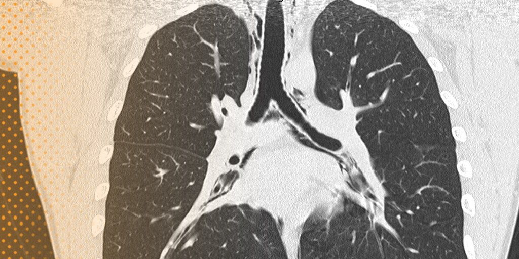 Univadis's tweet image. A 30-year-old man presents with #acuteonset #chestpain after #liftingweights, as well as with a progressive change in his voice and difficulty breathing x 1 day.
bit.ly/2J5FEoC