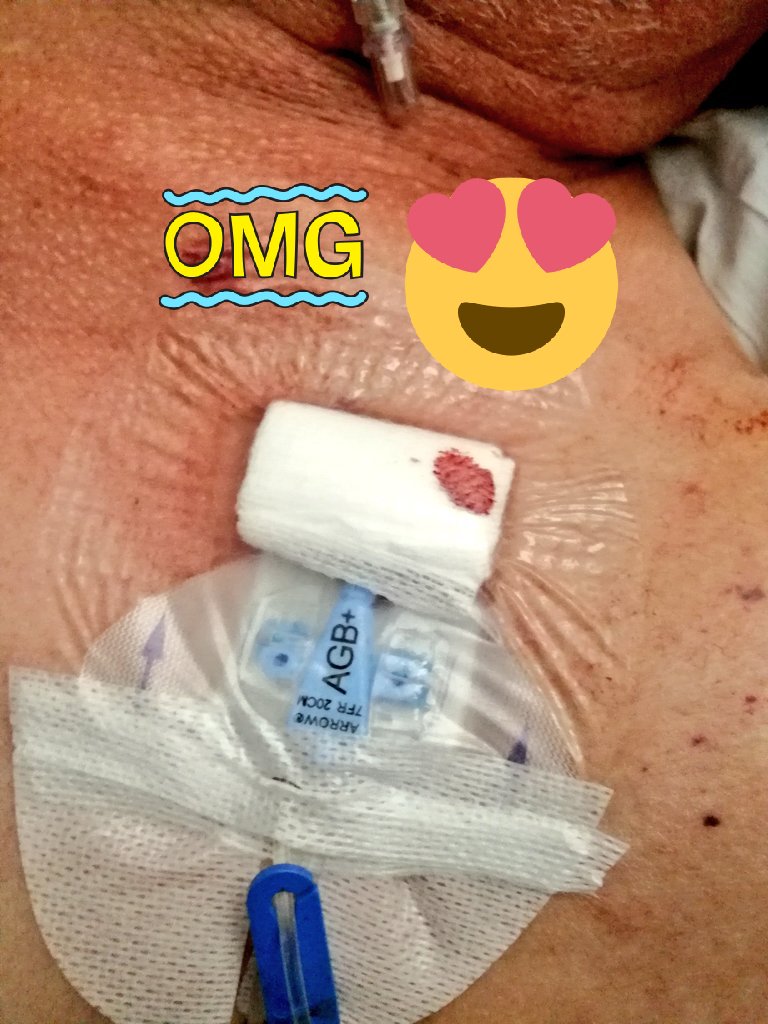 readelchuac's tweet photo. Probando los nuevos catéteres impregnados en plata y clorhexidina de arrow!!
#picc #piccteam #readelchuac #cvc #arrow #subclavia #sinsuturas https://t.co/TkxC8aGpkt